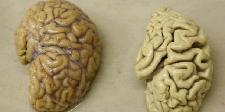 Imagen de un cerebro humano sometido a estudio. (Foto externa)