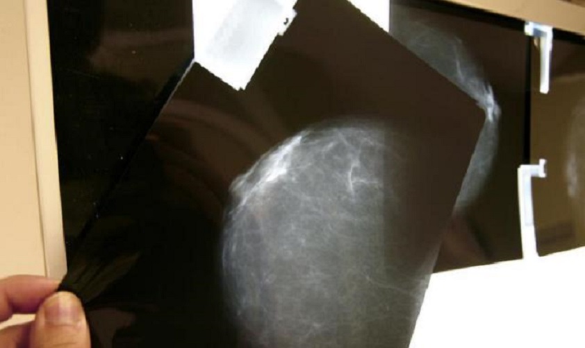Fotografía de archivo de una prueba radiológica de mama. (Foto EFE/Chema Moya)