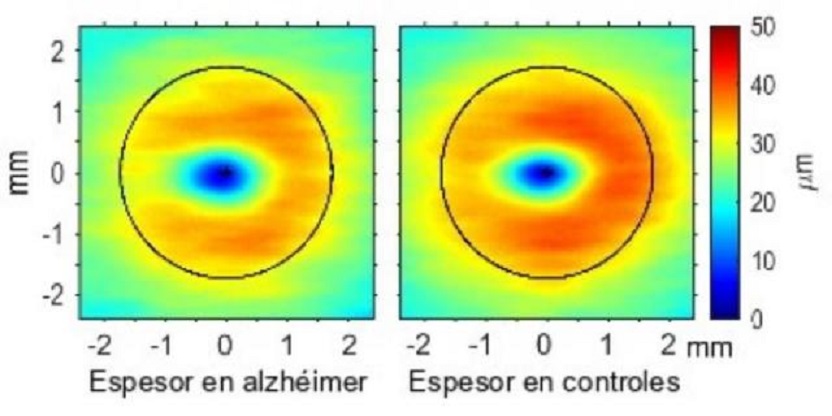 Algunas zonas de la retina experimentan cambios que pueden ayudar a diagnosticar de forma precoz la enfermedad del alzheimer. (Foto Universidad Complutense de Madrid)