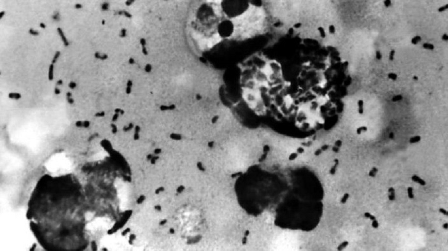 La peste bubónica se caracteriza por la inflamación de los ganglios linfáticos.